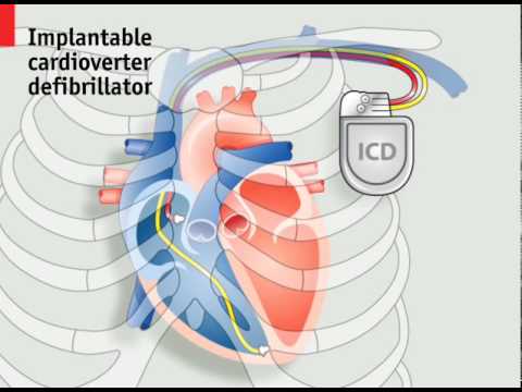 Videographic: Electric Beats - Pacemakers and the Human Heart