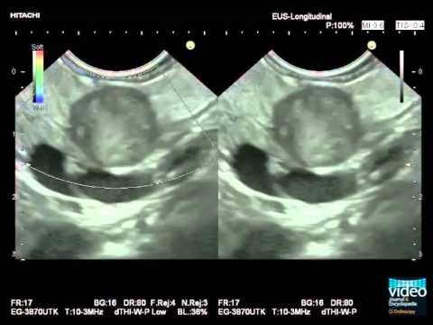 EUS in Solid Pancreatic Lesions: Detection, Characterization & Assessment of Resectability