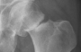 Hip fractures and other common breaks are predicted to increase with the ageing population. 