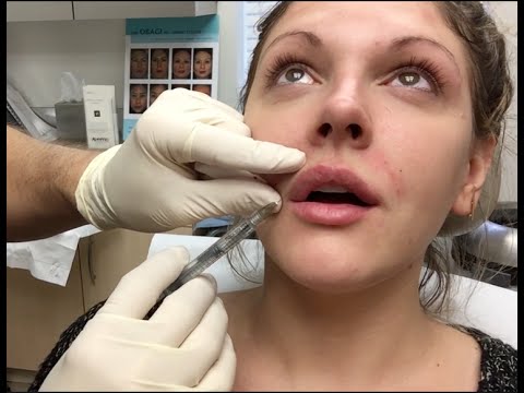 Getting Botox and Juvederm (lip injections): WARNING: GRAPHIC