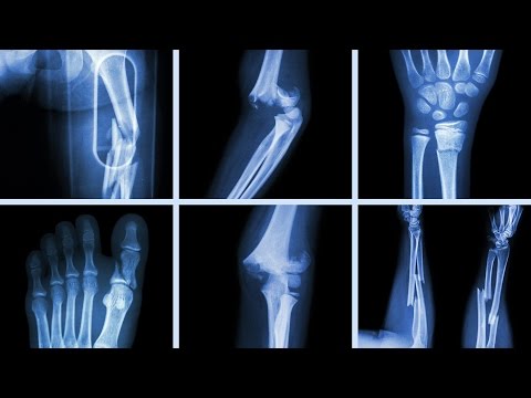 What Happens To Your Body When You Break A Bone