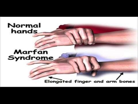 Marfan Syndrome