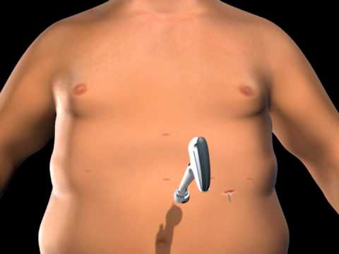 Gastric Band Surgery at My New Beginning Bariatric Surgery Center in Dallas