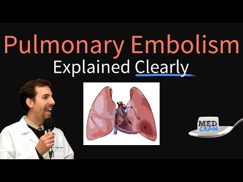 Pulmonary Embolism Explained Clearly