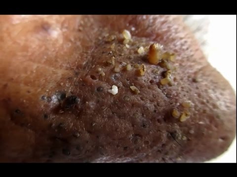 Nose Full Of Blackheads