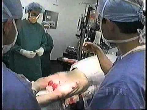 multiple amputation (motorcycle) - ER hospital emergency room surgical procedure documentary