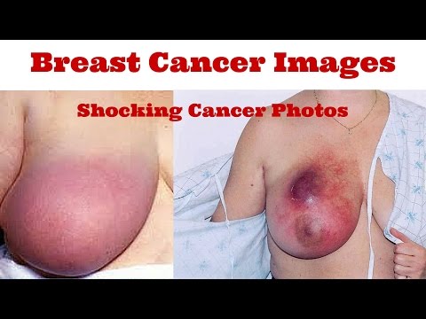 Breast Cancer Images | Shocking Photos of Breast Cancer