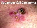 Understanding Squamous Cell Carcinoma (Skin Cancer #5)