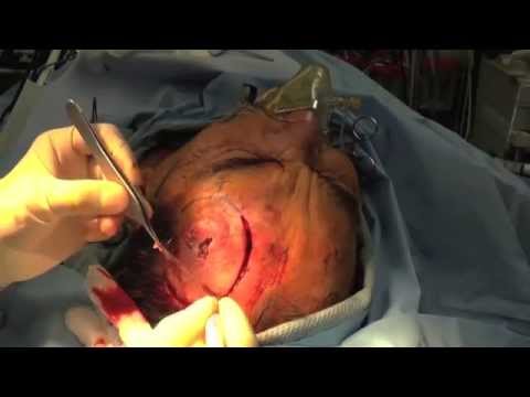 EXCISION OF LARGE SQUAMOUS CELL CARCINOMA - DR. TANVEER JANJUA - NEW JERSEY