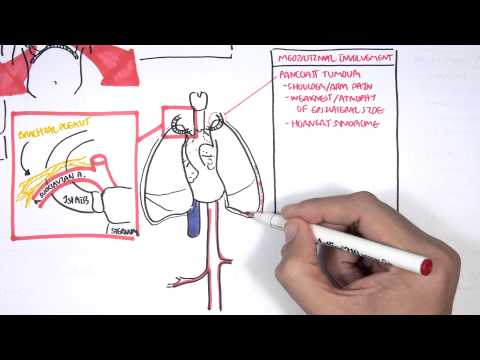 Lung Carcinoma (Lung cancer)