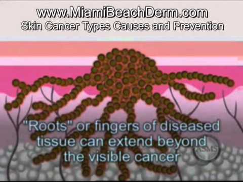 Skin cancer types treatment: melanoma basal cell carcinoma, squamous cell carcinoma