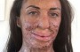 Turia Pitt had undergone more surgery for the injuries she sustained during an ultra marathon in 2011.