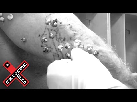 Chris Jericho gets tacks removed from his body after Extreme Rules: May 23, 2016