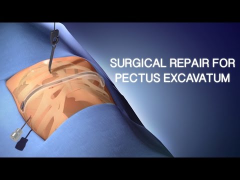 Pectus Excavatum Surgical Repair | A Cincinnati Children's Medical Animation