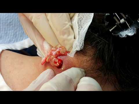 Drainage of Infected Epidermal Cyst