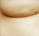 Claire Warner, 41, is raising awareness of a little-known warning sign of breast cancer: a barely noticeable dimple.