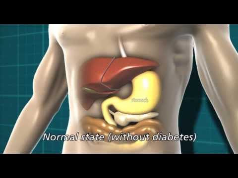 What is diabetes? | Diabetes UK