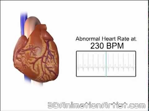 Normal Vs Accelerated Heart Rate