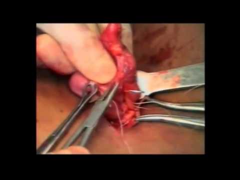 Operation of Appendix - Appendectomy - Operative Live Surgery by Dr Vaidya