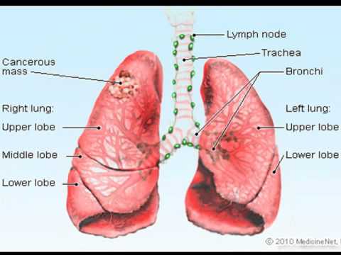 EARLY SIGNS OF LUNG CANCER TO WATCH OUT FOR