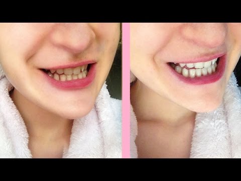 Crest white strips honest review