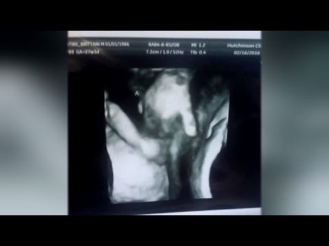 Dying Twin Caught on a Sonogram Holding Hands With Sister