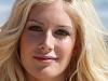 Heidi Montag: Implants ‘falling through my skin’