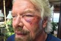 Branson suffered severe cuts to his knee, chin, shoulder and body. 