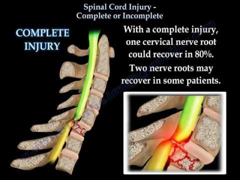 Spinal Cord Injury Complete Or Incomplete - Everything You Need To Know - Dr. Nabil Ebraheim