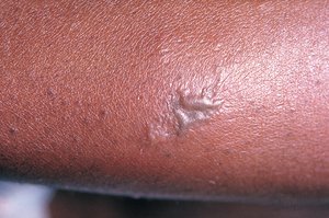 File - Gonorrhea, caused by Neisseria gonorrhoeae, if left untreated will enter the blood, thereby, spreading throughout the body. As is shown here, such full body dissemination may manifest itself as skin lesions in the form of gray pustules.