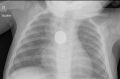 An x-ray showing a button battery lodged in the oesophagus of a 9-month-old boy.