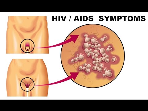 HIV SYMPTOMS (HIV, AIDS) " AAHC " -