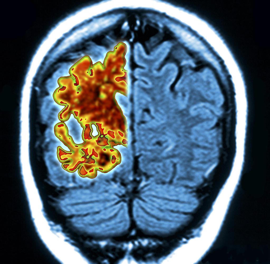 Grafik eines von Alzheimer betroffenen Gehirns