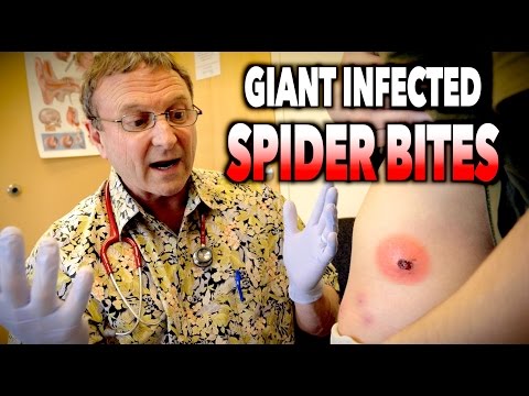 GIANT INFECTED SPIDER BITES! | Dr. Paul