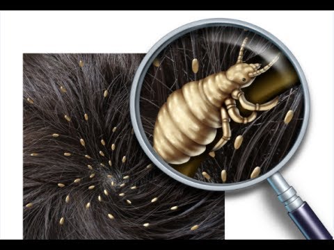 How to Get Rid of Head Lice Fast