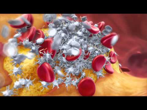 Acute Coronary Syndrome (ACS) Pathology