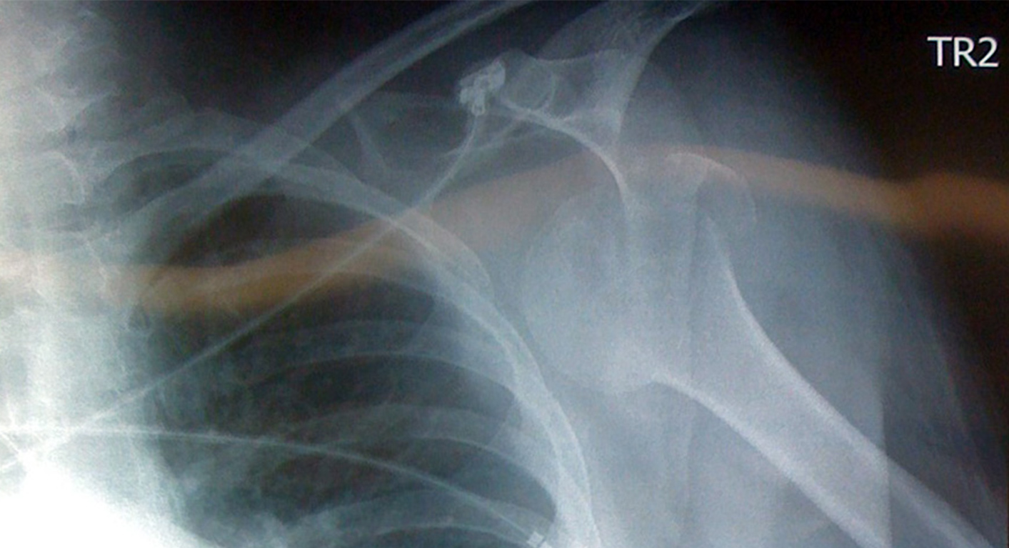 Shoulder X-Ray