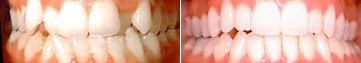 Severe Teeth Crowding