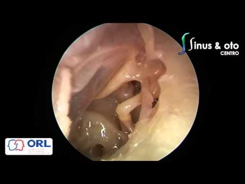 Dissection Chile 2015 (Middle and Inner Ear)