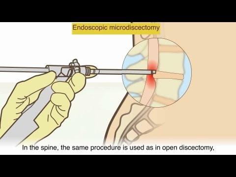 A herniated disc - What is it and what surgical treatments are available?