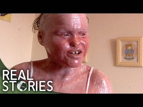 My Skin Could Kill Me (Medical Documentary) - Real Stories