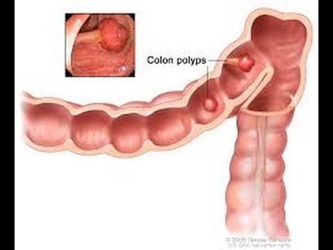 What is a Colon Polyp? | Los Angeles Colonoscopy