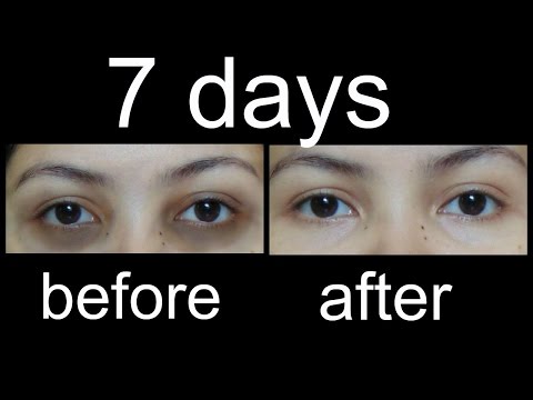 काले घेरों से कैसे छुटकारा पाएं/magical Home Remedies to remove Under eye Dark Circles (Hindi)