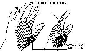 Paresthesia, is a sensation of tingling, tickling, prickling, or burning of a person's skin.