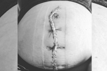 An unnamed mum has shared her post-caesarean scar in a photo. 