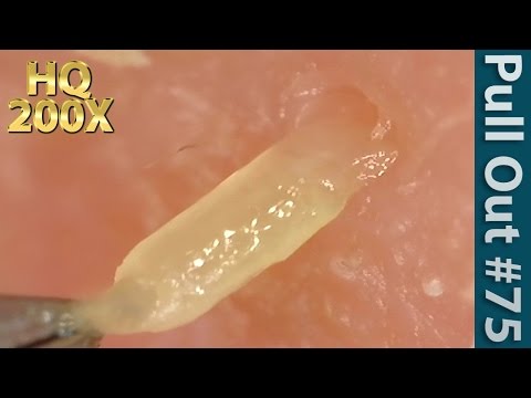 #75 Pull Out Blackheads Close up 200X - Blackheads Removal