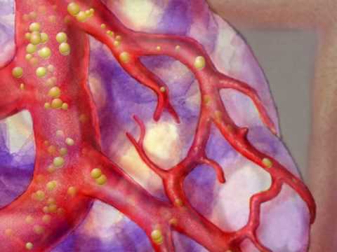 TACE and Anti-Angiogenic Drug Treatments for Liver Cancer