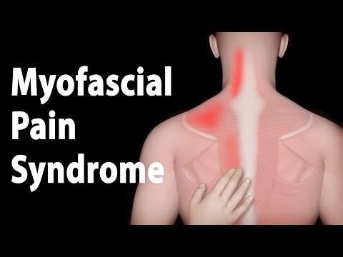 Myofascial Pain Syndrome and Trigger Points Treatments, Animation.