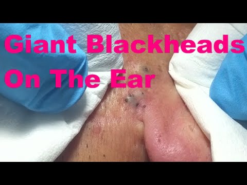 Giant Blackheads On The Ear - Part I -