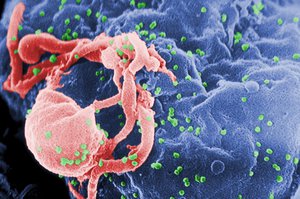 This undated photo provided by the Centers for Disease Control and Prevention shows a scanning electron micrograph of multiple round bumps of the HIV-1 virus on a cell surface.